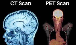 Read more about the article PET Scan vs. CT Scan: Understanding the Differences and Applications